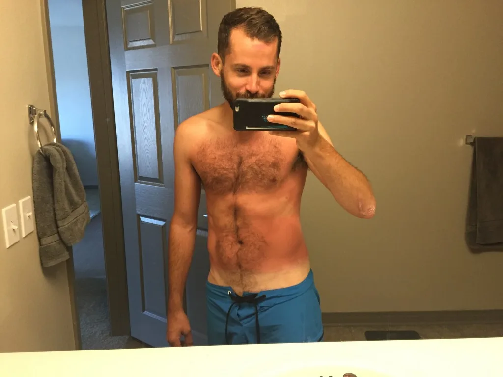sunburn